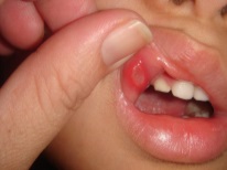 Aphthous stomatitis in a child