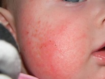 Red cheeks during diathesis in a child