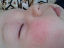 Red cheeks during diathesis in a child