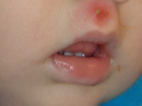 Estomatitis por herpes en la piel de un niño