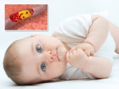 Hemophilia in children