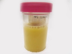 White flakes in the urine of a child