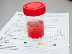 Erythrocytes in the urine of a child