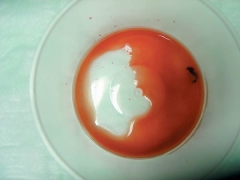 Blood in the urine of a child