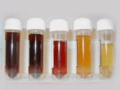 Dark urine in a child