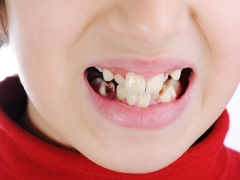 Cause della placca nera sui denti dei bambini