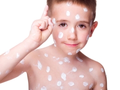 Acyclovir for chickenpox: instructions for use