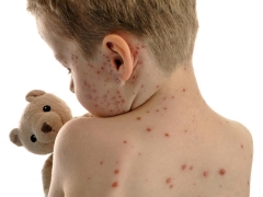 Chickenpox incubation period