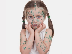 How to get chickenpox?