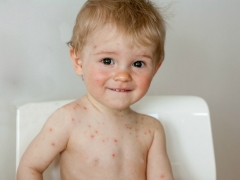 Varicella-zoster virus și diferențele sale față de virusul herpes și infecția enterovirus