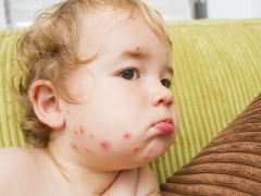 Prevention of chickenpox