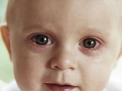 Conjunctivitis in children