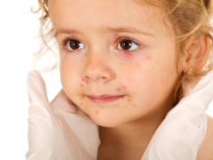 Rubella in children: symptoms, treatment and prevention