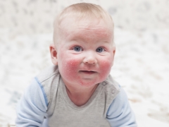 Atopic dermatitis in children