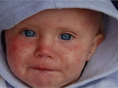 What does measles look like in children: initial symptoms