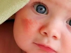 What does dermatitis look like in children?