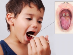 Síntomas, tratamiento y prevención de la difteria en niños.