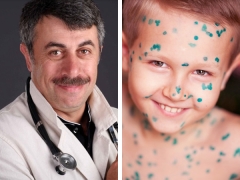 Dr. Komarovsky: what is chickenpox and how to treat it