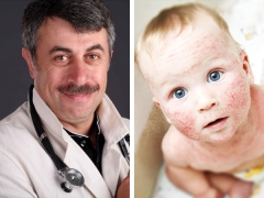 Dr. Komarovsky on the treatment of atopic dermatitis in children