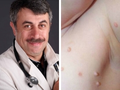 Dr. Komarovsky sul trattamento dei bambini con mollusco contagioso