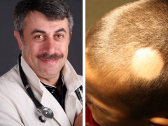 Dr. Komarovsky sulle cause della perdita di capelli nei bambini