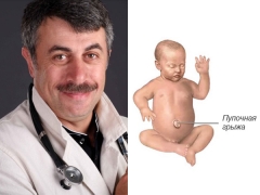 Dr. Komarovsky about umbilical hernia in newborns and small children