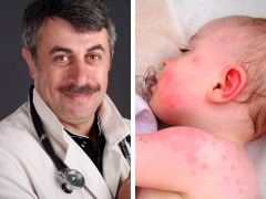 Doktor Komarovsky tungkol sa roseola