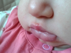 Herpes op de lip van de baby