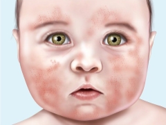 Pyoderma in children