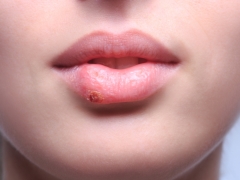 Symptoms and treatment of herpes in children