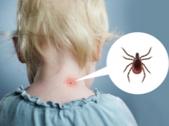 What to do if a child has been bitten by a tick?