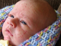 Hormonal rash sa newborns and infants