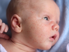 Calore pungente sulla faccia da bambino