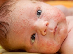 Síntomas y tratamiento del calor espinoso en recién nacidos y bebés