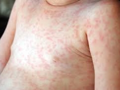 Rash on baby’s belly