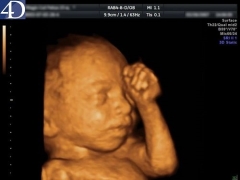 4D ultrasound during pregnancy