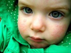 What if there is a rash on the face of a child?