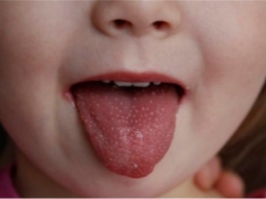 What to do if a child has a rash in the mouth?