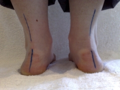 Treatment for flat-valgus foot in a child