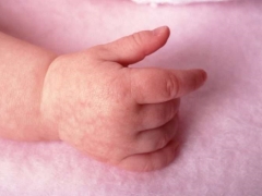 Why can a rash appear in the hands of a child and what to do?