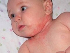 Prickly heat on baby's neck