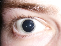 Causes of dilated pupils in a child