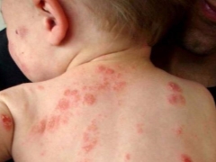 Rash on baby's back