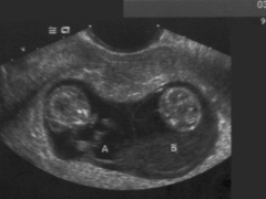 ¿Qué es la CTP fetal y cómo debería ser normal durante el embarazo?