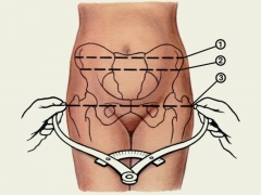 Narrow pelvis during pregnancy and its clinical form