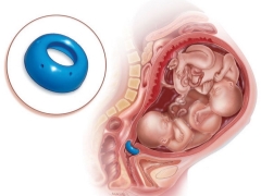 Why establish an obstetric pessary during pregnancy and when it is removed?