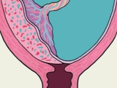 What does marginal placenta previa mean, what is it dangerous for and what does it affect?