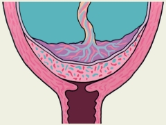 What does complete placenta previa mean and how is it dangerous during pregnancy?