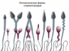 ¿Qué formas patológicas de esperma son y cómo afectan el éxito de la concepción?