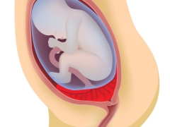 De positie van de placenta ten opzichte van de interne keel